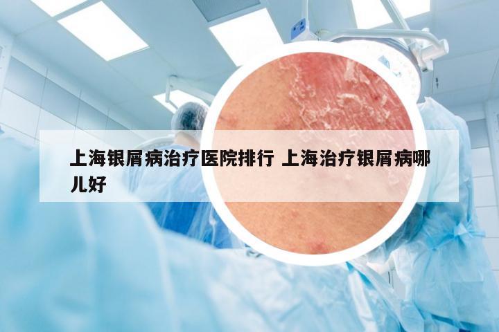 上海银屑病治疗医院排行 上海治疗银屑病哪儿好