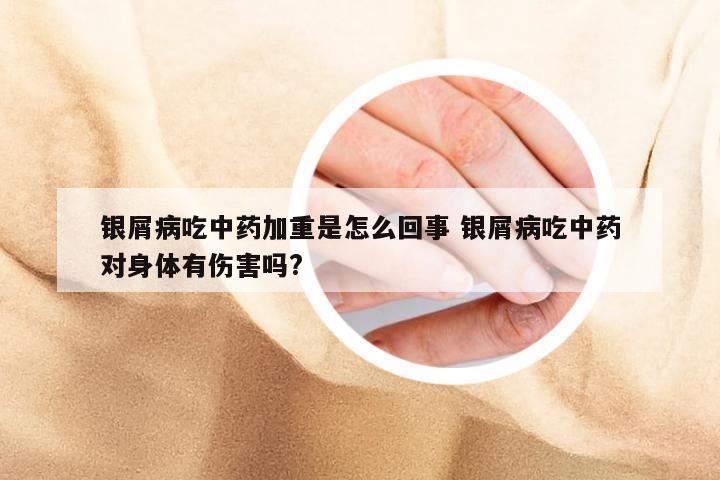 银屑病吃中药加重是怎么回事 银屑病吃中药对身体有伤害吗?