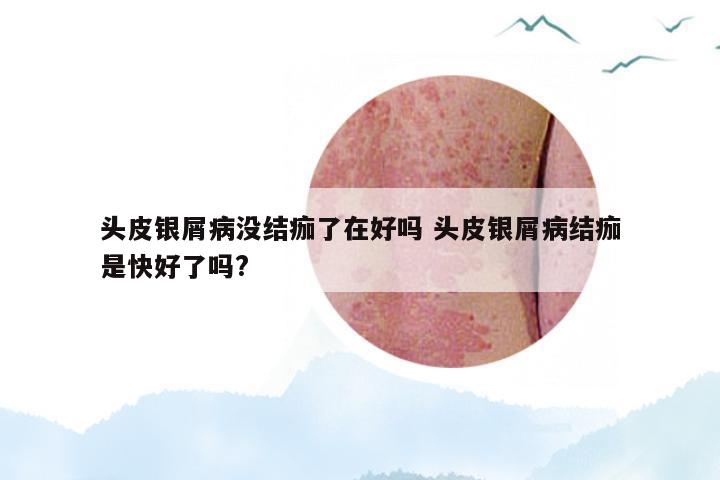 头皮银屑病没结痂了在好吗 头皮银屑病结痂是快好了吗?