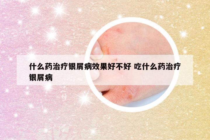 什么药治疗银屑病效果好不好 吃什么药治疗银屑病