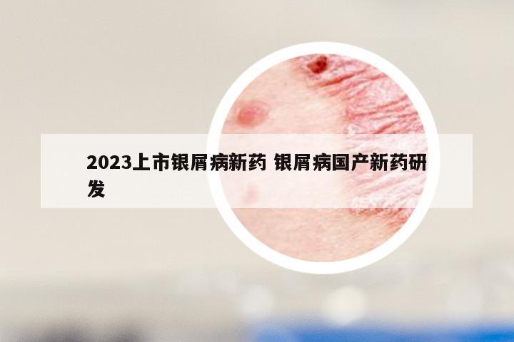 2023上市银屑病新药 银屑病国产新药研发