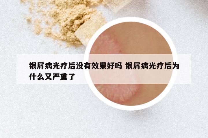 银屑病光疗后没有效果好吗 银屑病光疗后为什么又严重了