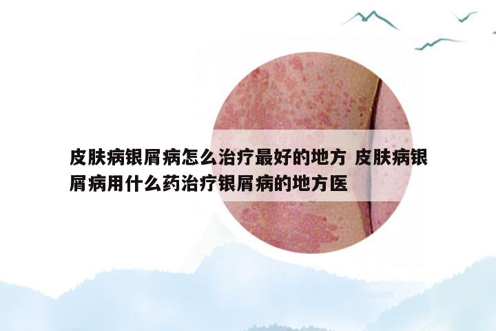 皮肤病银屑病怎么治疗最好的地方 皮肤病银屑病用什么药治疗银屑病的地方医