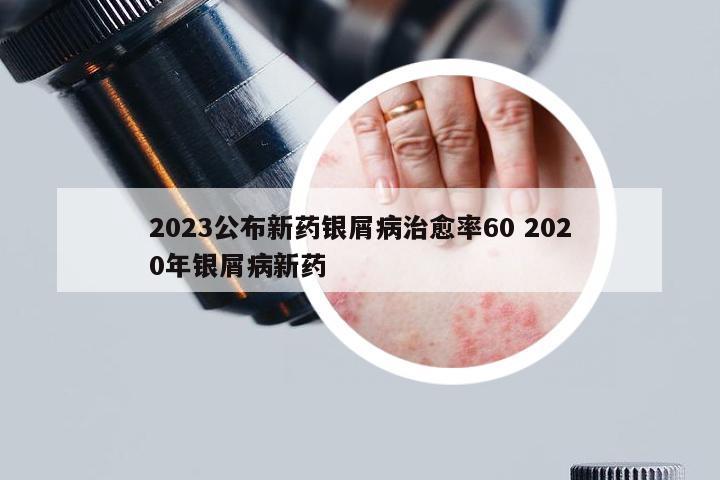 2023公布新药银屑病治愈率60 2020年银屑病新药