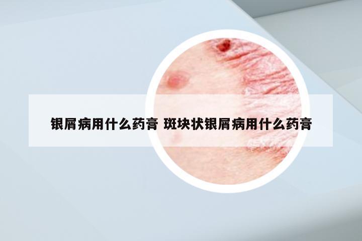 银屑病用什么药膏 斑块状银屑病用什么药膏