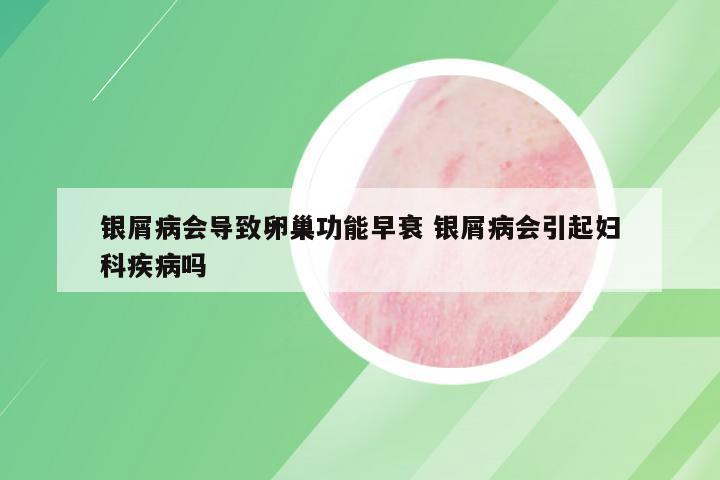 银屑病会导致卵巢功能早衰 银屑病会引起妇科疾病吗