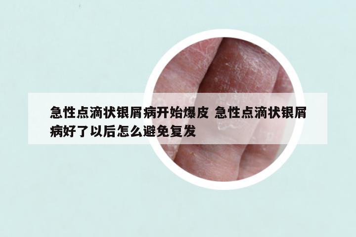 急性点滴状银屑病开始爆皮 急性点滴状银屑病好了以后怎么避免复发