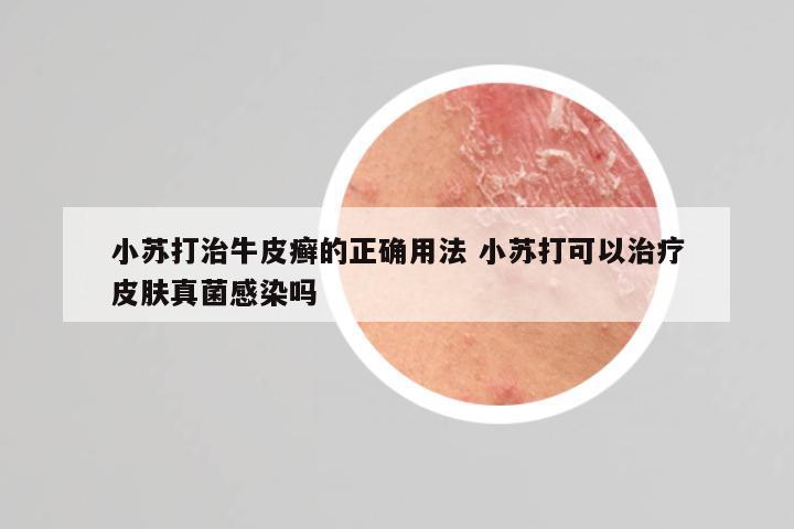 小苏打治牛皮癣的正确用法 小苏打可以治疗皮肤真菌感染吗