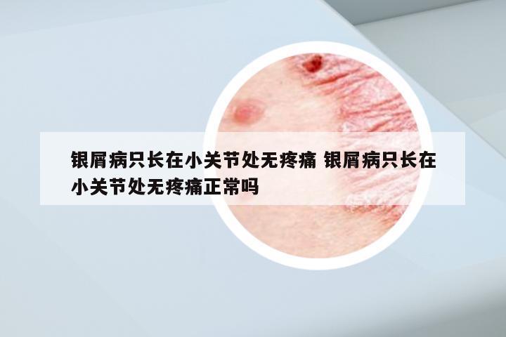 银屑病只长在小关节处无疼痛 银屑病只长在小关节处无疼痛正常吗