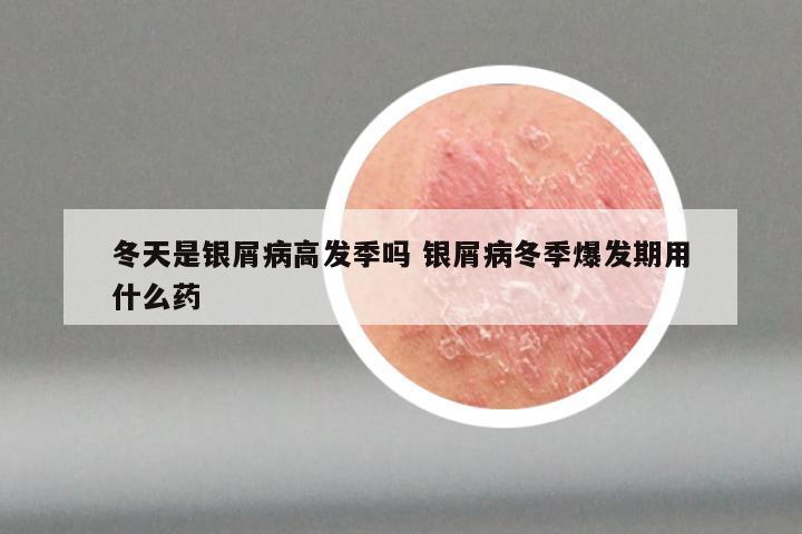 冬天是银屑病高发季吗 银屑病冬季爆发期用什么药