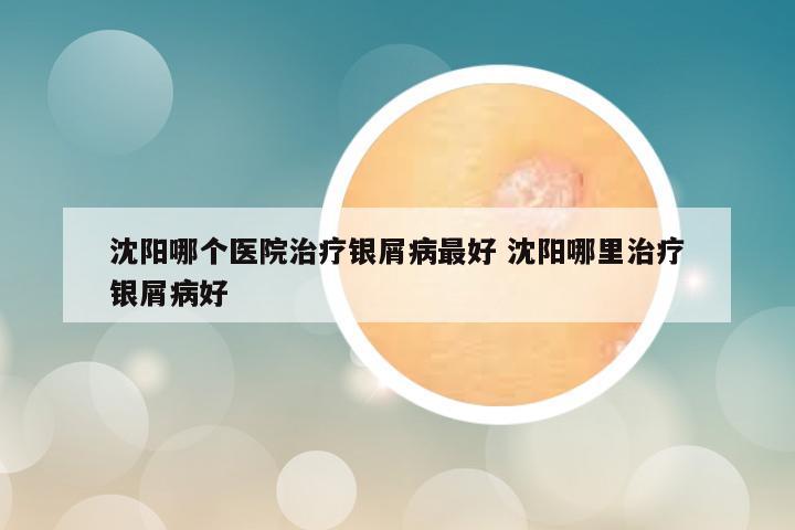 沈阳哪个医院治疗银屑病最好 沈阳哪里治疗银屑病好