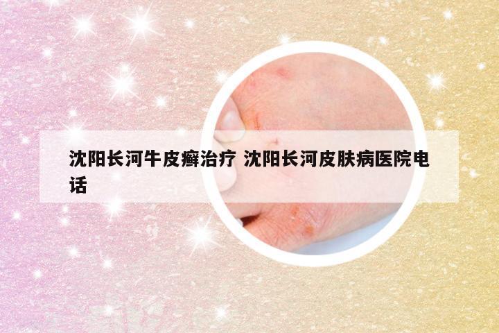 沈阳长河牛皮癣治疗 沈阳长河皮肤病医院电话