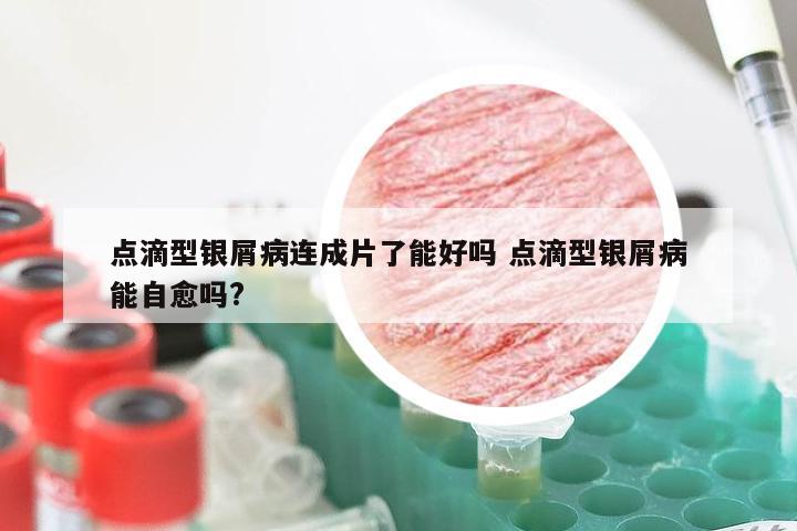 点滴型银屑病连成片了能好吗 点滴型银屑病能自愈吗?