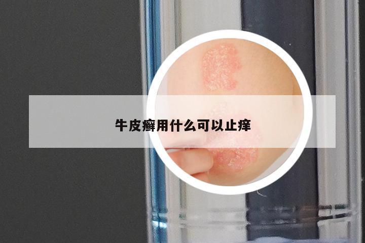 牛皮癣用什么可以止痒