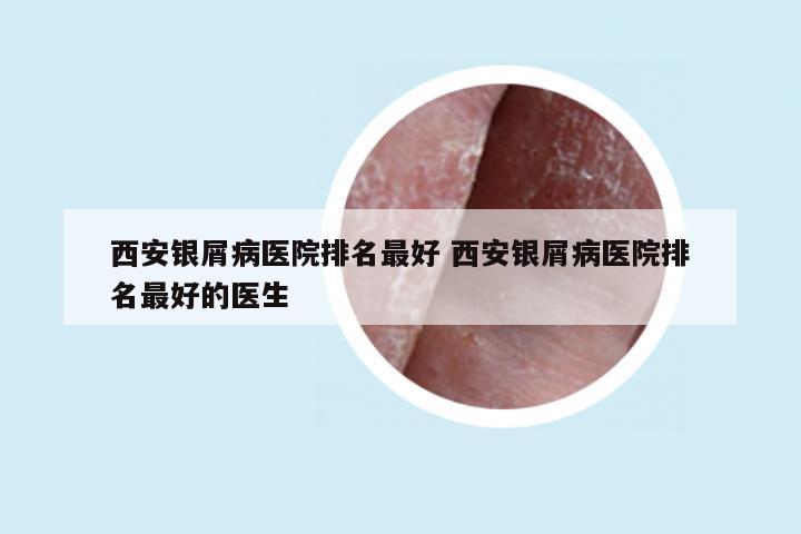 西安银屑病医院排名最好 西安银屑病医院排名最好的医生