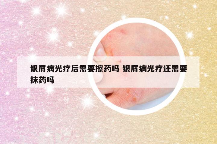 银屑病光疗后需要擦药吗 银屑病光疗还需要抹药吗