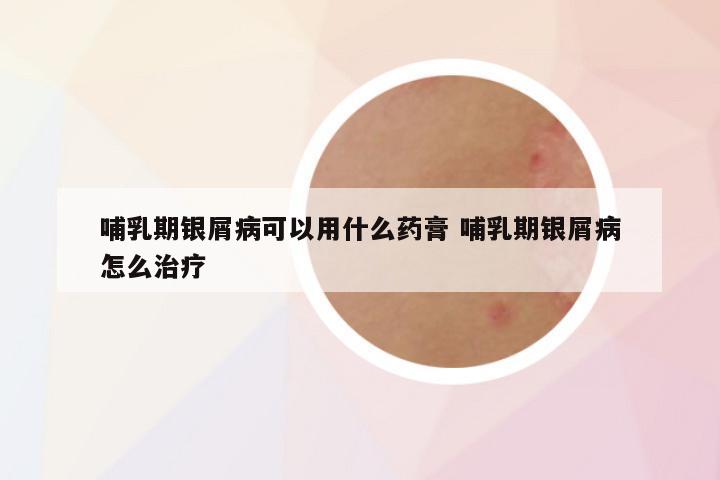 哺乳期银屑病可以用什么药膏 哺乳期银屑病怎么治疗