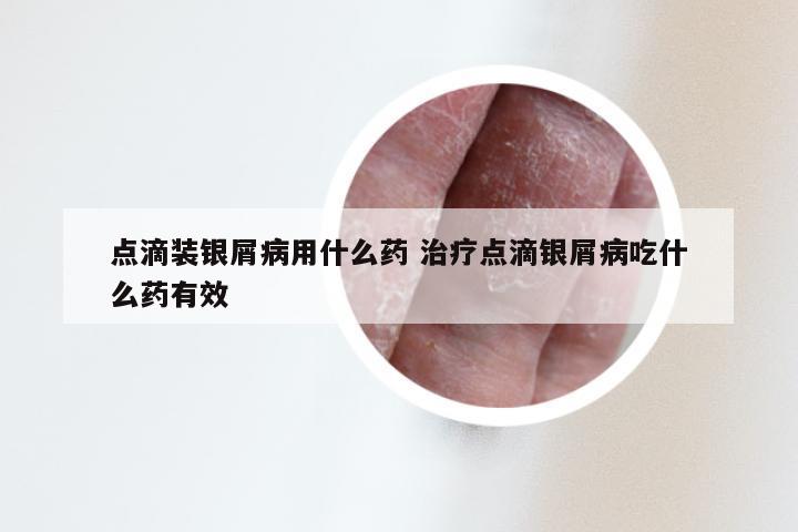 点滴装银屑病用什么药 治疗点滴银屑病吃什么药有效