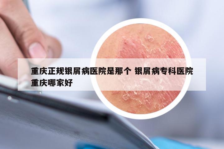 重庆正规银屑病医院是那个 银屑病专科医院重庆哪家好