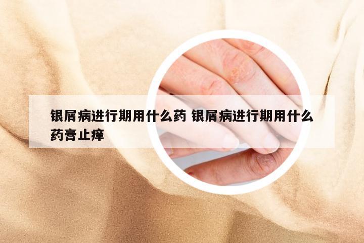 银屑病进行期用什么药 银屑病进行期用什么药膏止痒