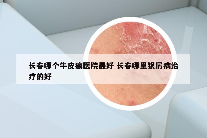 长春哪个牛皮癣医院最好 长春哪里银屑病治疗的好