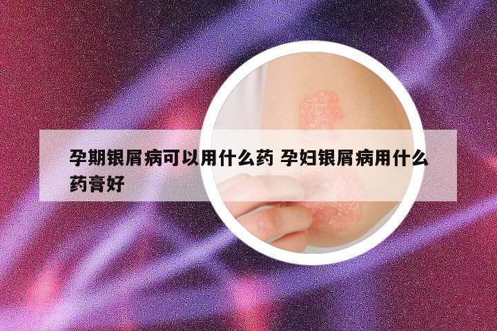 孕期银屑病可以用什么药 孕妇银屑病用什么药膏好