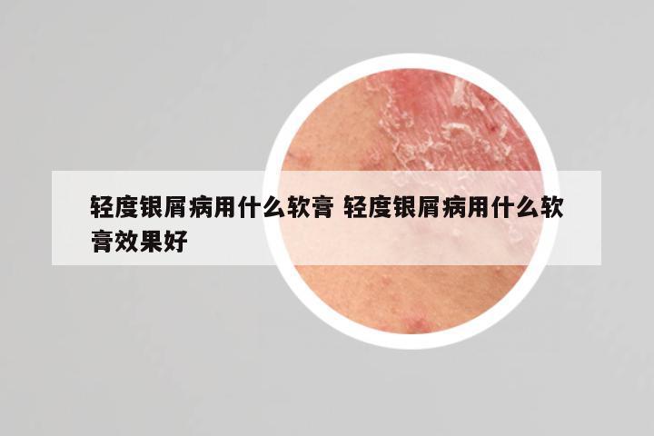 轻度银屑病用什么软膏 轻度银屑病用什么软膏效果好