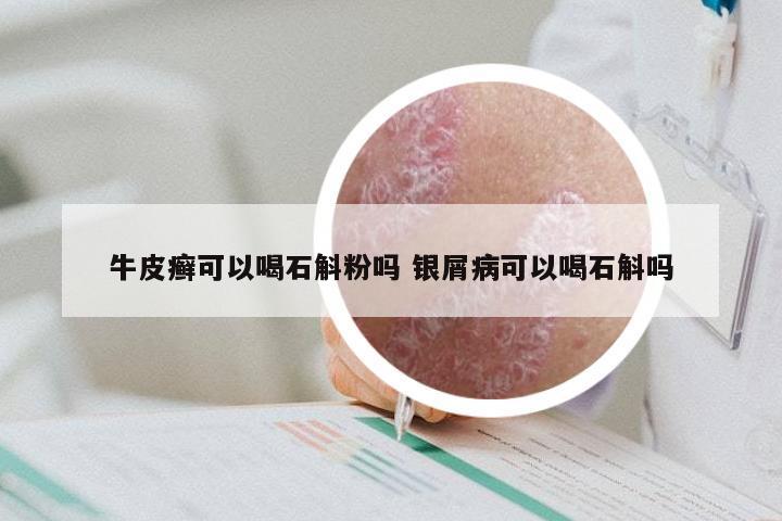 牛皮癣可以喝石斛粉吗 银屑病可以喝石斛吗