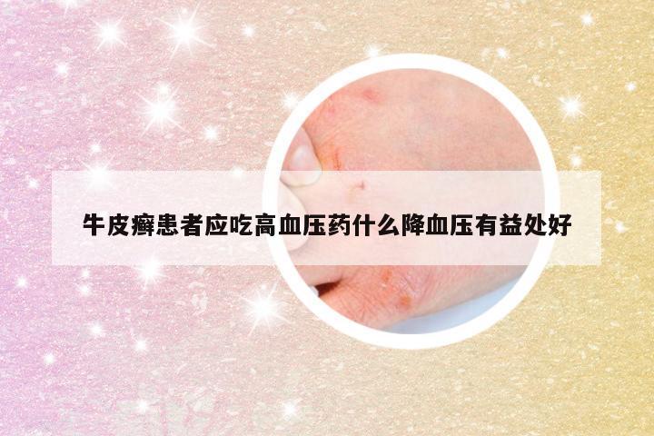 牛皮癣患者应吃高血压药什么降血压有益处好