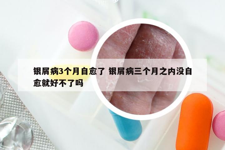 银屑病3个月自愈了 银屑病三个月之内没自愈就好不了吗