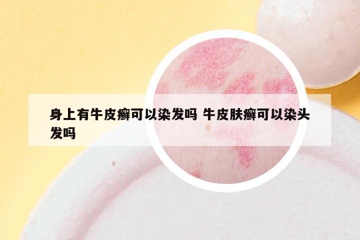 身上有牛皮癣可以染发吗 牛皮肤癣可以染头发吗