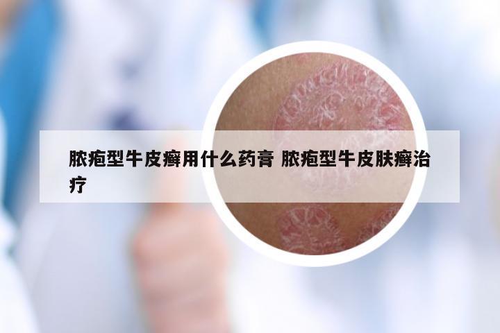 脓疱型牛皮癣用什么药膏 脓疱型牛皮肤癣治疗