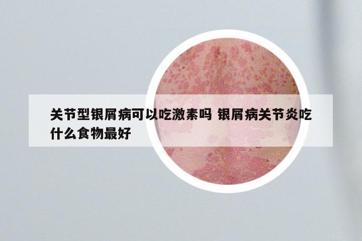 关节型银屑病可以吃激素吗 银屑病关节炎吃什么食物最好