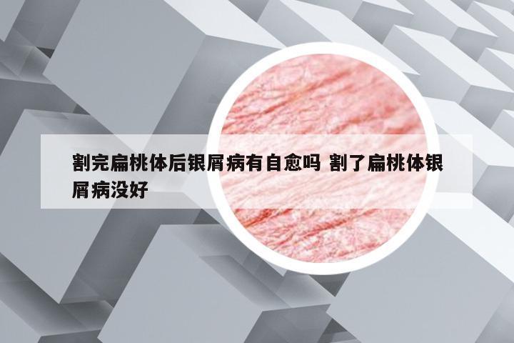 割完扁桃体后银屑病有自愈吗 割了扁桃体银屑病没好