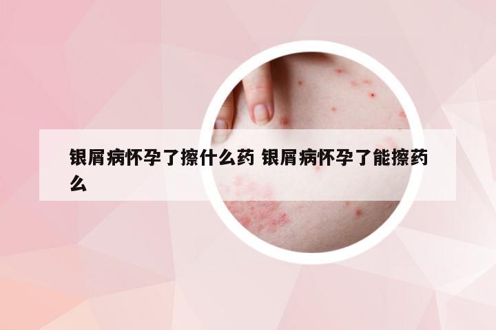 银屑病怀孕了擦什么药 银屑病怀孕了能擦药么