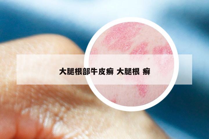 大腿根部牛皮癣 大腿根 癣