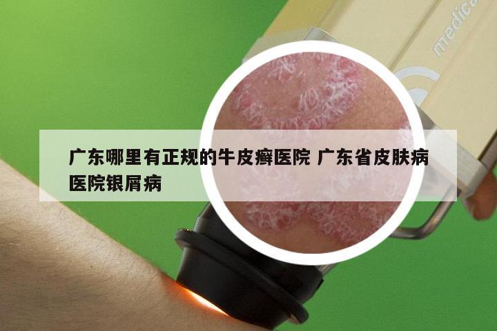 广东哪里有正规的牛皮癣医院 广东省皮肤病医院银屑病