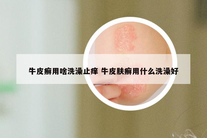 牛皮癣用啥洗澡止痒 牛皮肤癣用什么洗澡好