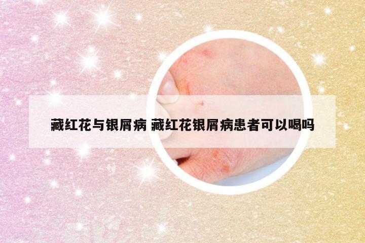 藏红花与银屑病 藏红花银屑病患者可以喝吗