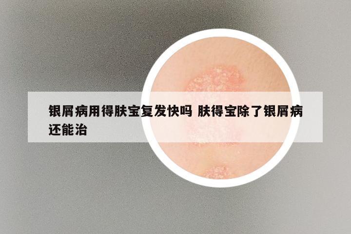 银屑病用得肤宝复发快吗 肤得宝除了银屑病还能治