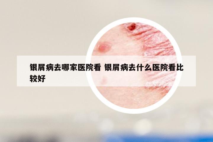 银屑病去哪家医院看 银屑病去什么医院看比较好