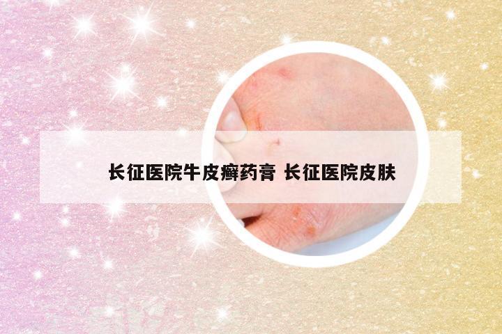 长征医院牛皮癣药膏 长征医院皮肤