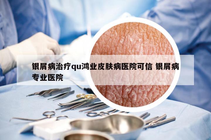 银屑病治疗qu鸿业皮肤病医院可信 银屑病专业医院