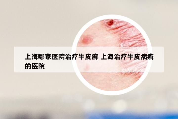 上海哪家医院治疗牛皮癣 上海治疗牛皮病癣的医院