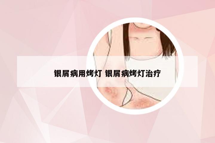 银屑病用烤灯 银屑病烤灯治疗