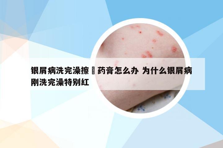 银屑病洗完澡擦廯药膏怎么办 为什么银屑病刚洗完澡特别红