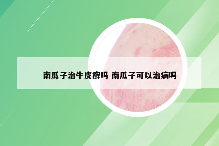 南瓜子治牛皮癣吗 南瓜子可以治病吗