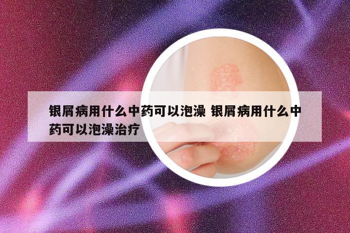 银屑病用什么中药可以泡澡 银屑病用什么中药可以泡澡治疗