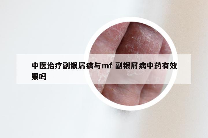 中医治疗副银屑病与mf 副银屑病中药有效果吗