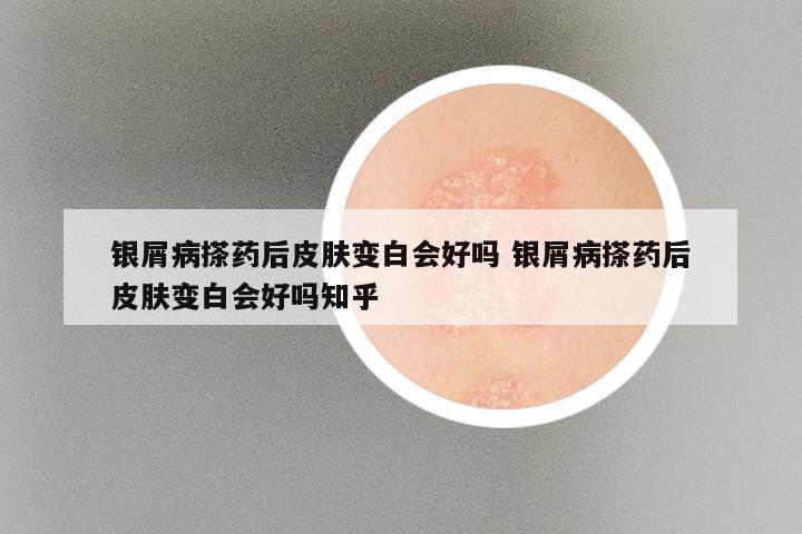 银屑病搽药后皮肤变白会好吗 银屑病搽药后皮肤变白会好吗知乎